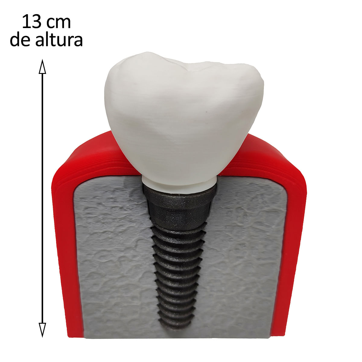 Implante Dental Análise Modelo Dentário Dente 3D Anatomia